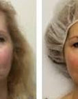 NEUROTRIS DYNAMIC MICROCURRENT FACE/NECK PACKAGE