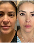 CRYSTALFRAX SKIN TIGHTENING with T-SHOCK Package