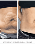 T-SHOCK® Fat Reduction Package