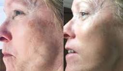 Neurotris Face Treatment Single
